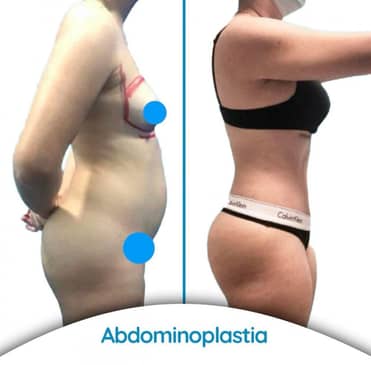 Slider image (7) Dr. Alvaro Uribe - Plastic Surgery in Colombia